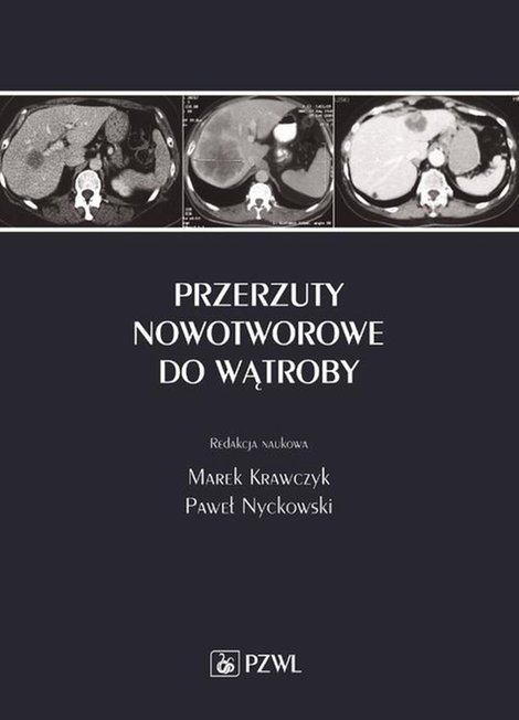 ebooki: Przerzuty nowotworowe do wątroby &ndash; ebook