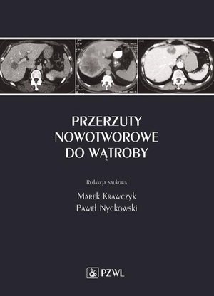 Przerzuty nowotworowe do wątroby – ebook
