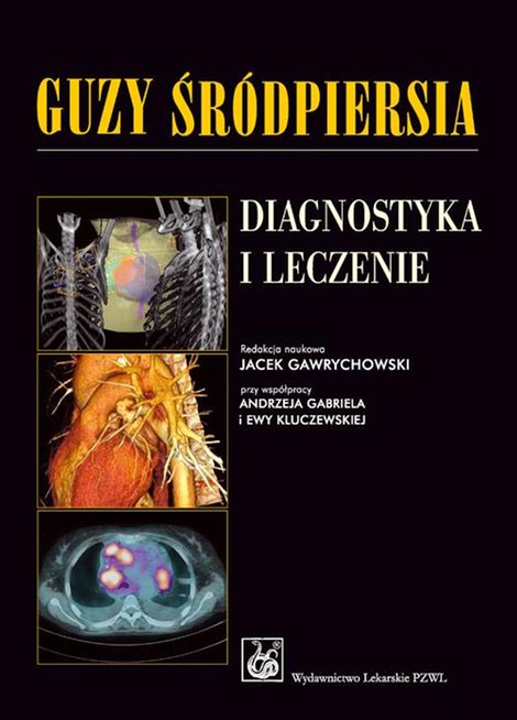 ebooki: Guzy śródpiersia. Diagnostyka i leczenie – ebook